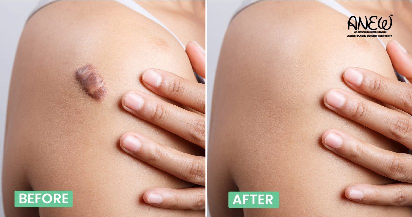 Keloid Treatment